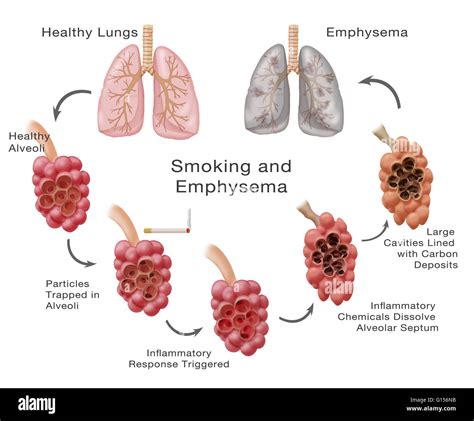 高齢者 肺気腫 余命：未来への希望と現実の狭間で